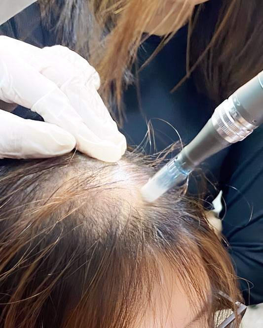 Volupropol Full Hair Therapy with Microneedling