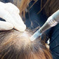 Volupropol Full Hair Therapy with Microneedling