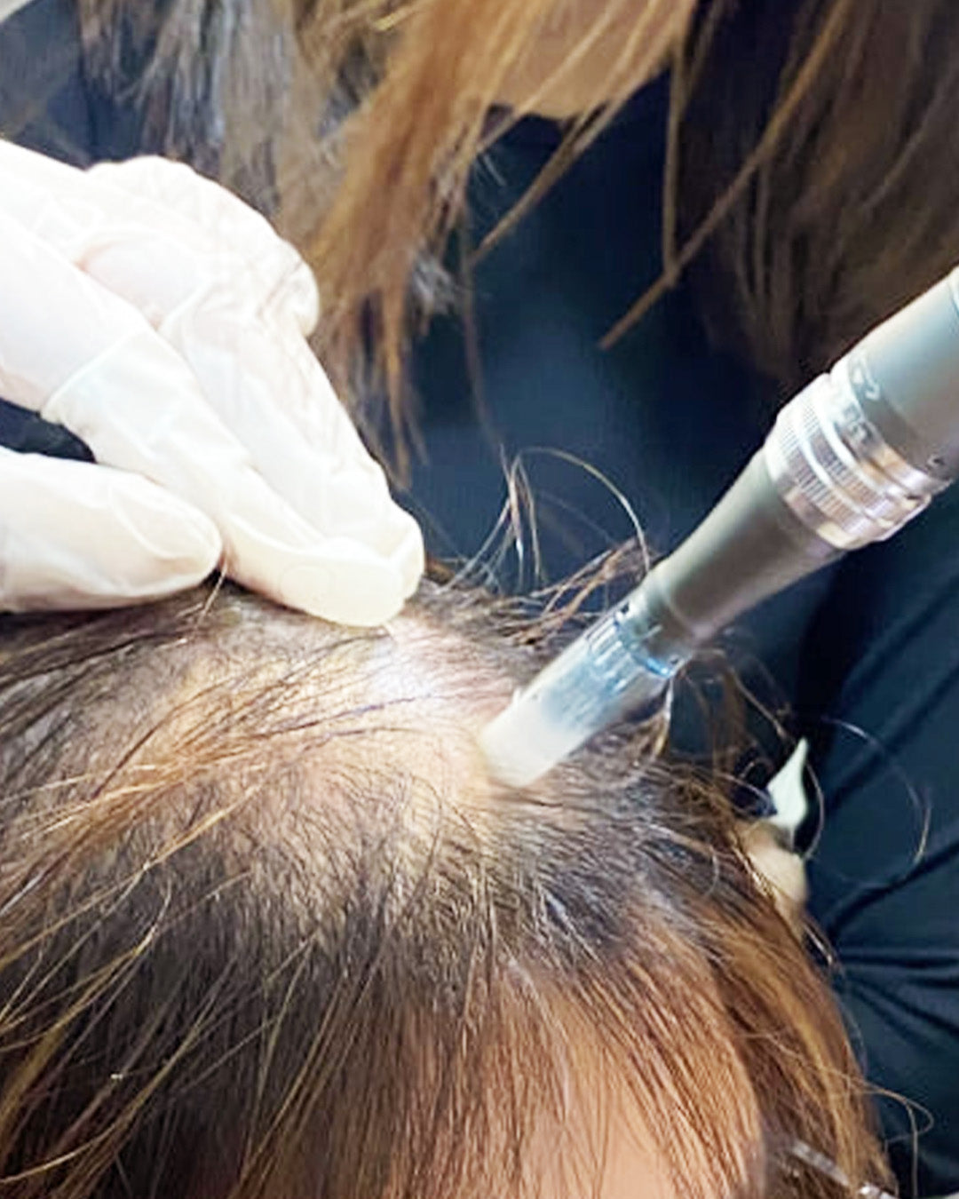 Volupropol Full Hair Therapy with Microneedling